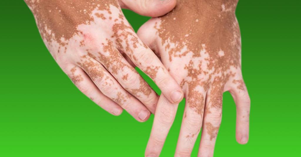 Is Vitiligo a Rare Disease?